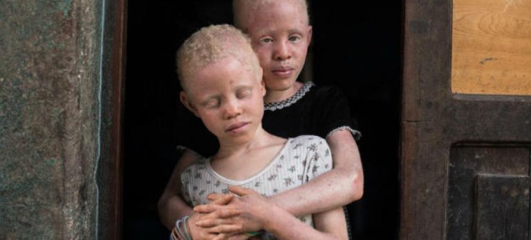 Albinos. Fonte UN News