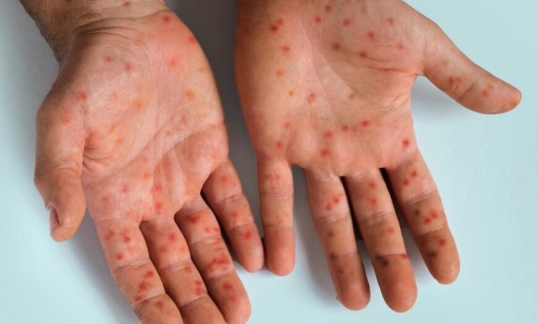 como-se-pega-mpox-entenda-as-formas-de-transmissao-do-virus-594